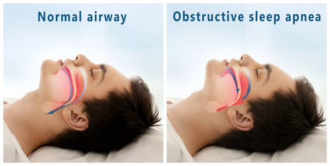 Understanding Sleep Apnea: What is AHI?