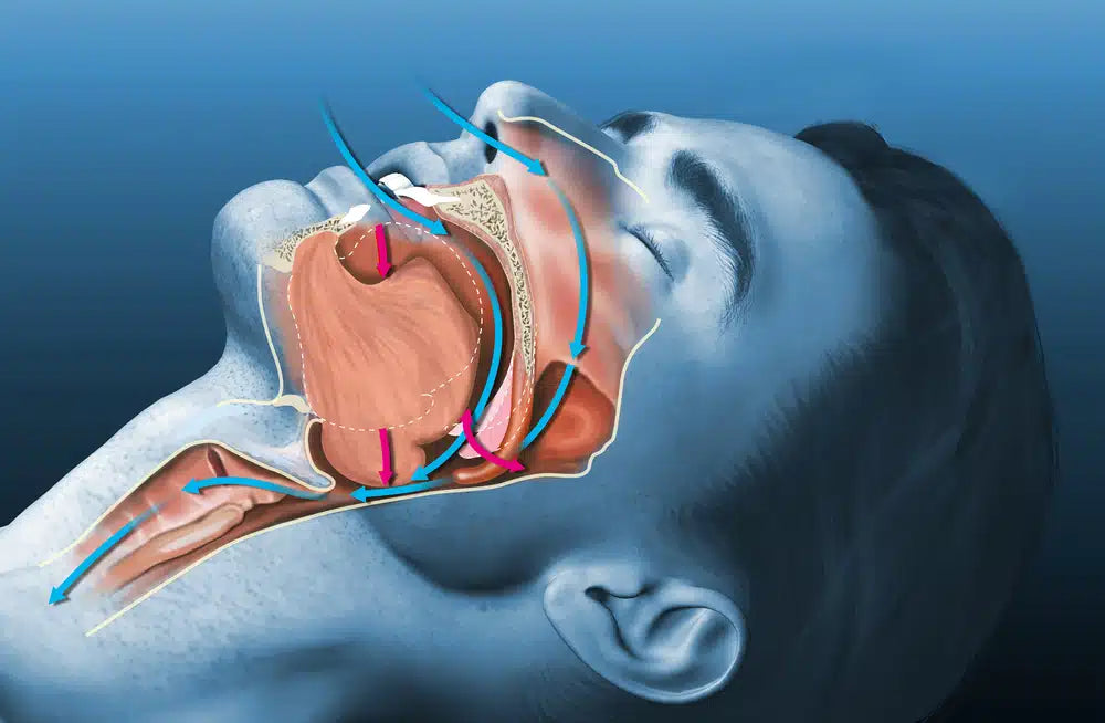 What Is Obstructive Sleep Apnea? | MedCram Doctor Explains